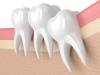 About Orthodontist Dubai Wisdom Tooth Removal