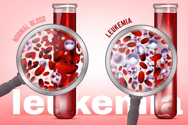 What is Leukemia? Warning Signs and Prevention