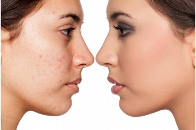 What Are The Types Of Acne Treatment Available?