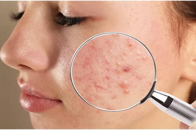 Understanding the Different Types of Acne and How to Treat Them