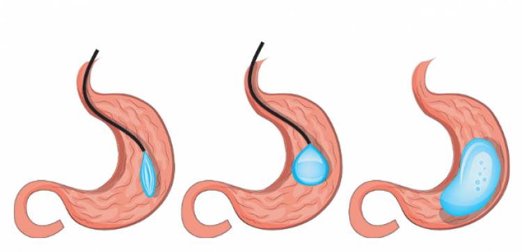 Details & Benefits of Intragastric Balloon Surgery