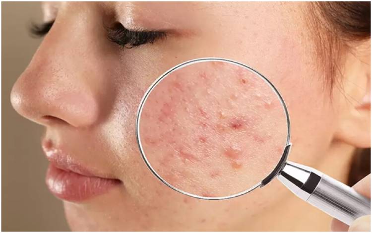 Understanding the Different Types of Acne and How to Treat Them